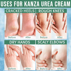 KANZA 40% Urea Cream for Cracked Feet & Hands | Foot Callus & Skin Repair